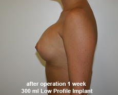plastic-surgery-breast-augmentation